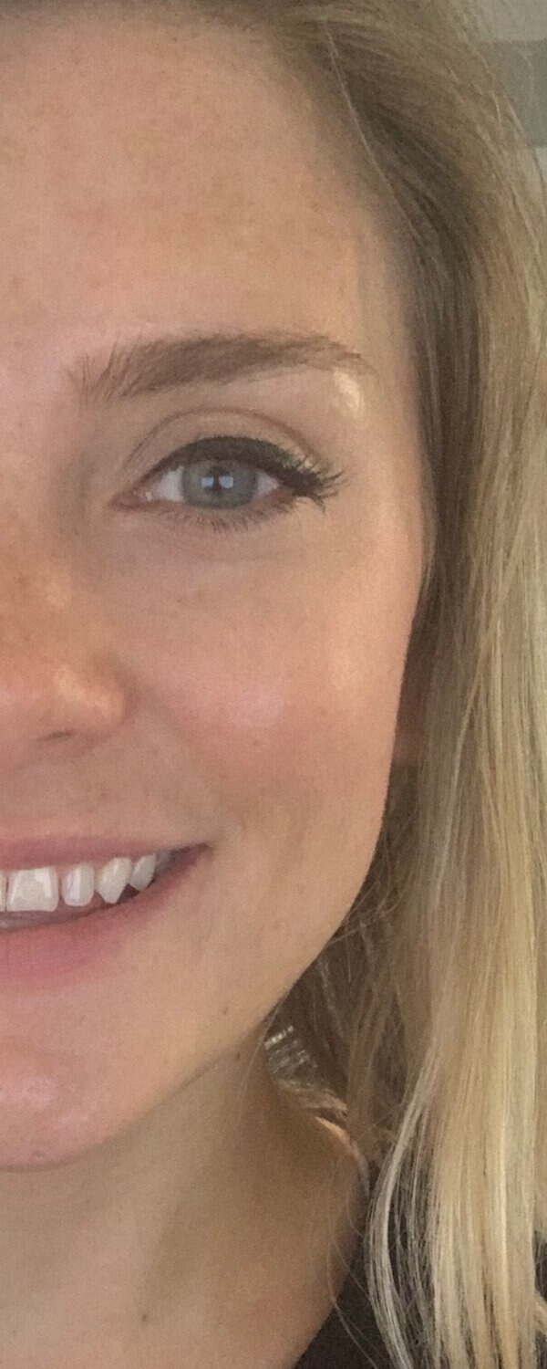 After Blue Peel treatment