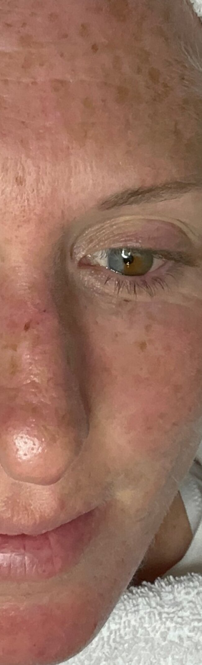 Before Diamond Tome HydroPlus treatment